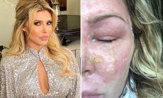 Ex-modelo teve queimaduras de segundo grau no rosto após tratamento para psoríase: "Só quero chorar"
