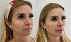 Antes e depois: Mãe de Viih Tube, do BBB 21, faz harmonização facial