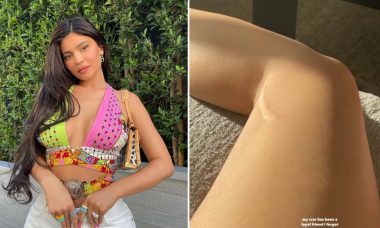 Kylie Jenner posta foto da cicatriz e reflete: "Amiga fiel"