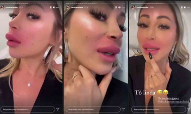 Carol Narizinho fica com os lábios com o dobro do tamanho após preenchimento labial . Foto: reprodução Instagram
