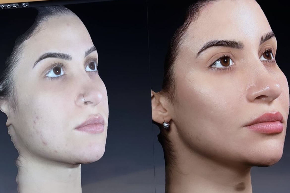 Bianca Andrade mostra antes e depois de harmonização facial