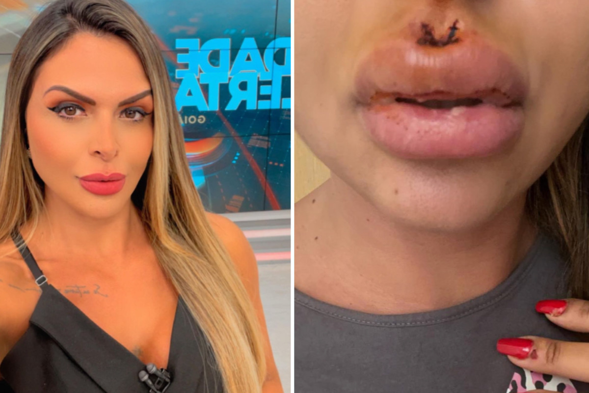 Jornalista mostra como ficou sua boca após agressão pelo ex-namorado