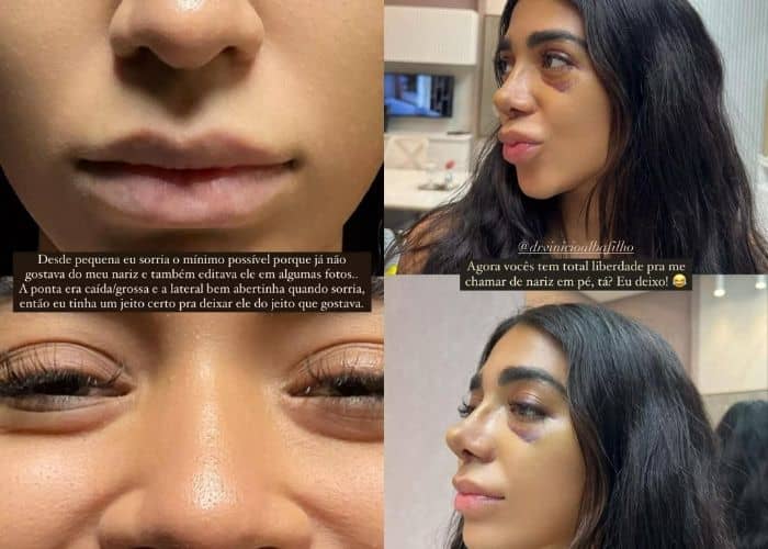 Dhiovanna Barbosa se emociona ao ver nariz após cirurgia plástica