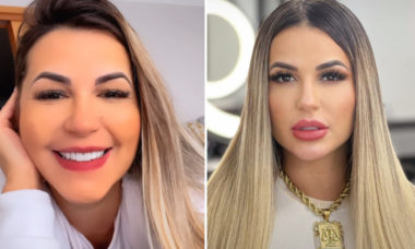 Antes e depois: Deolane Bezerra retira preenchimento labial