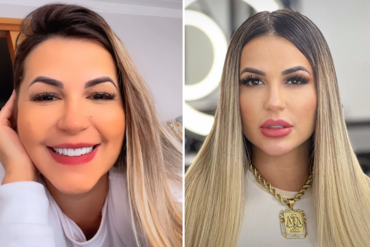 Antes e depois: Deolane Bezerra retira preenchimento labial