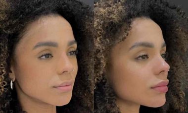 Antes e depois: Brunna Gonçalves faz harmonização facial