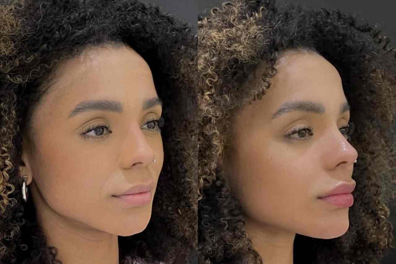 Antes e depois: Brunna Gonçalves faz harmonização facial