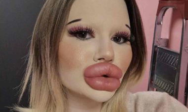 Influenciadora com 'maiores lábios do mundo' pretende quebrar novo recorde