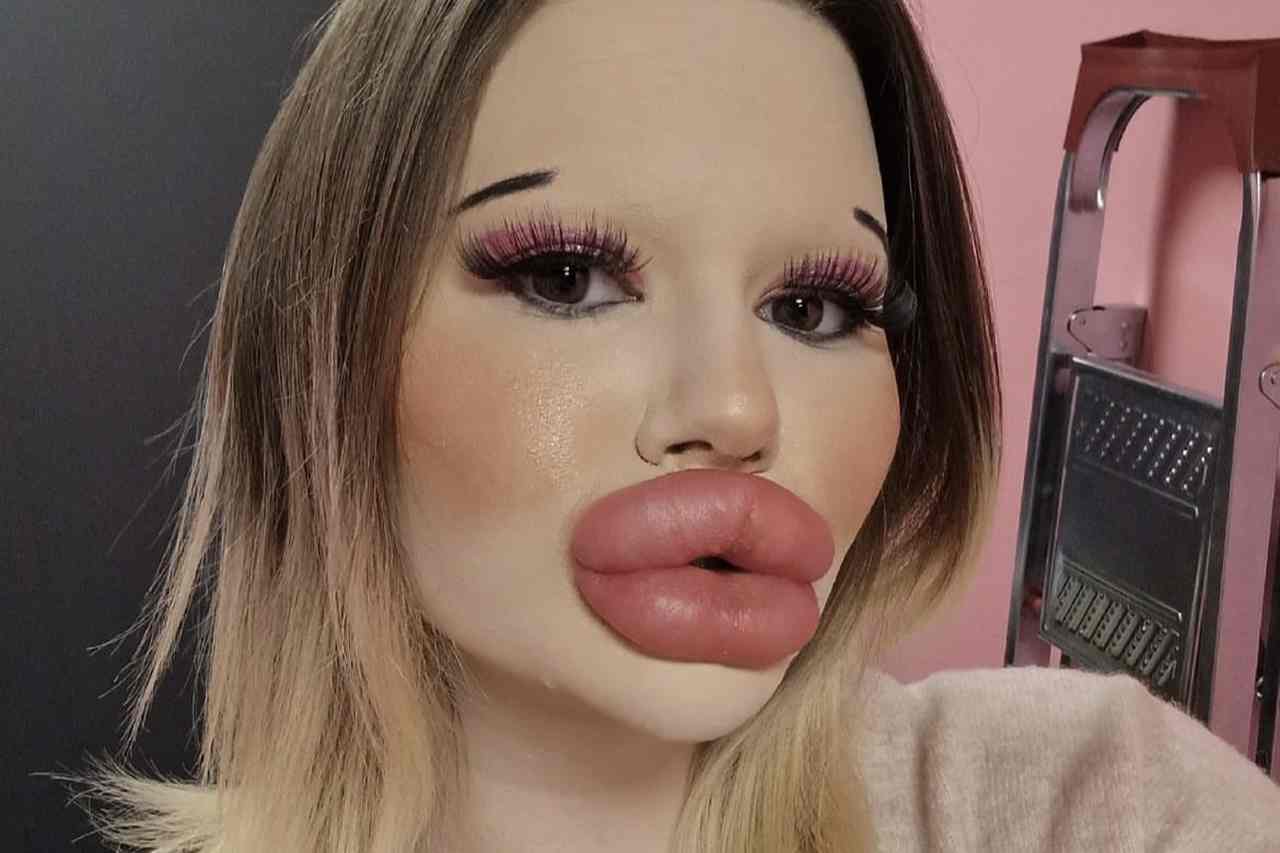 Influenciadora com 'maiores lábios do mundo' pretende quebrar novo recorde