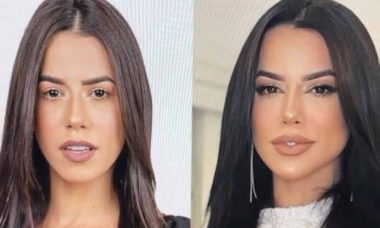 Ex-BBB Larissa Tomásia surpreende com antes e depois de harmonização facial
