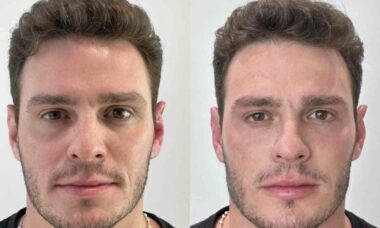 Ex-BBB Gustavo faz harmonização facial; veja antes e depois