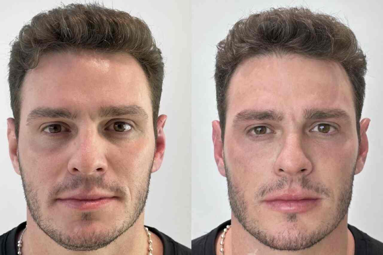 Ex-BBB Gustavo faz harmonização facial; veja antes e depois