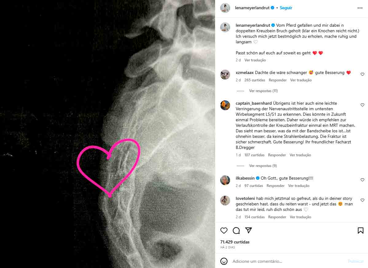 Lena também compartilhou uma foto do raio-X no Instagram