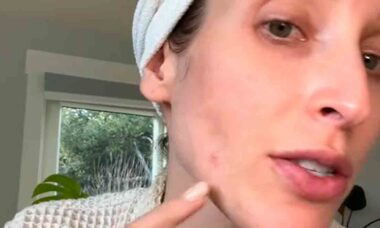Vídeo: Dermatologista revela o tipo de espinha que você NUNCA deve espremer