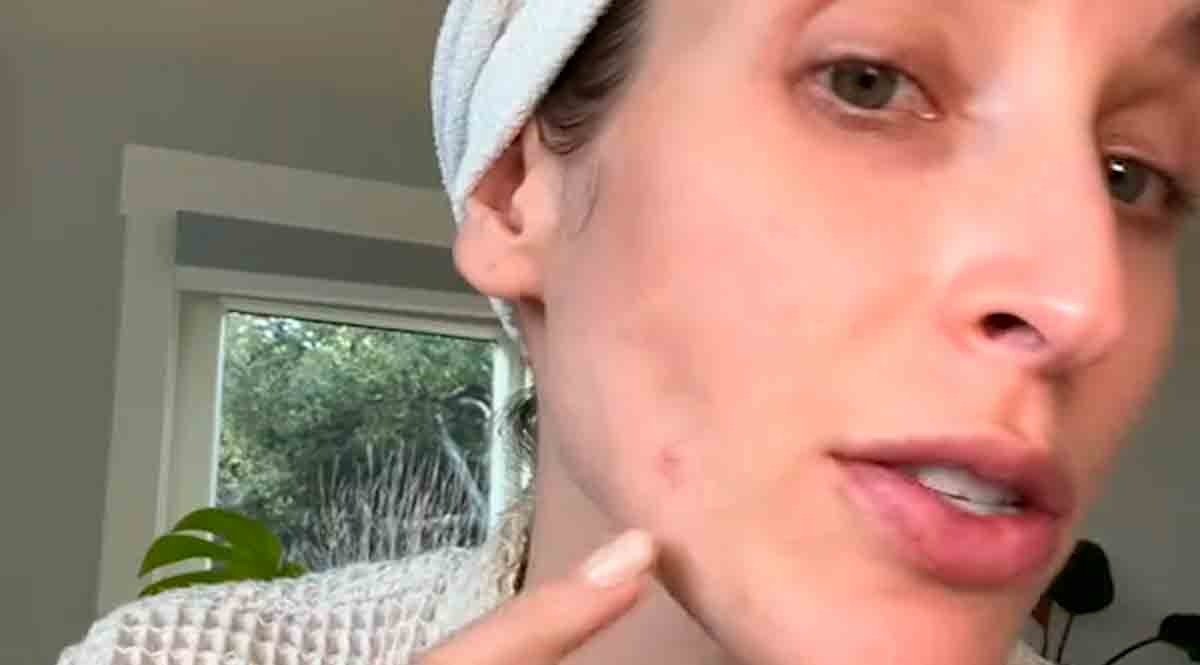 Vidéo : La dermatologue révèle le type de bouton que vous ne devez JAMAIS percer