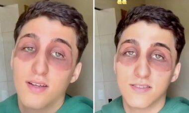 "Torakan purema": Nuori herää turvonnein silmin ja järkyttää sosiaalisessa mediassa. Kuva: TikTokin toisto