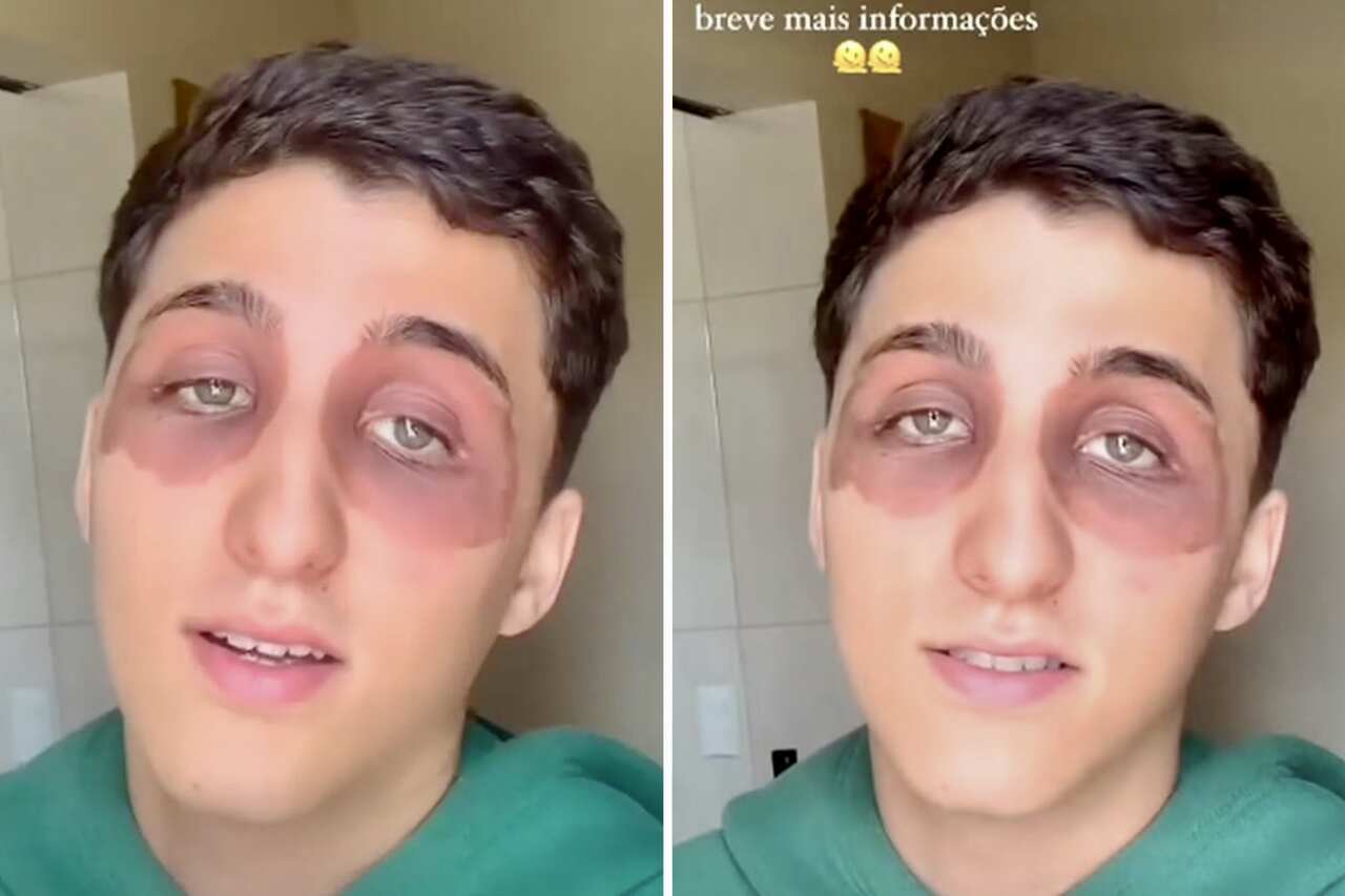 "Štípnutí od švába": mladý se probudil s otoky v očích a šokuje na sociálních sítích. Foto: Reprodukce TikTok