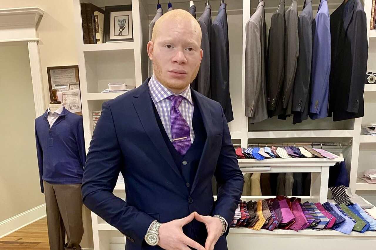 Influencer conhecido como o 'albino mais bonito do mundo' é acusado de aplicar golpe de US$ 500.000