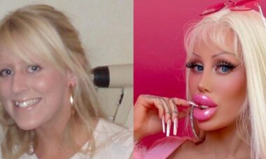 “Barbie humana” mostra antes e depois de gastar US$ 126 mil em cirurgias plásticas