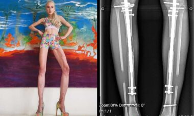 Modelo alemã enfrenta complicações graves após gastar US$ 160 mil em cirurgia de alongamento de pernas