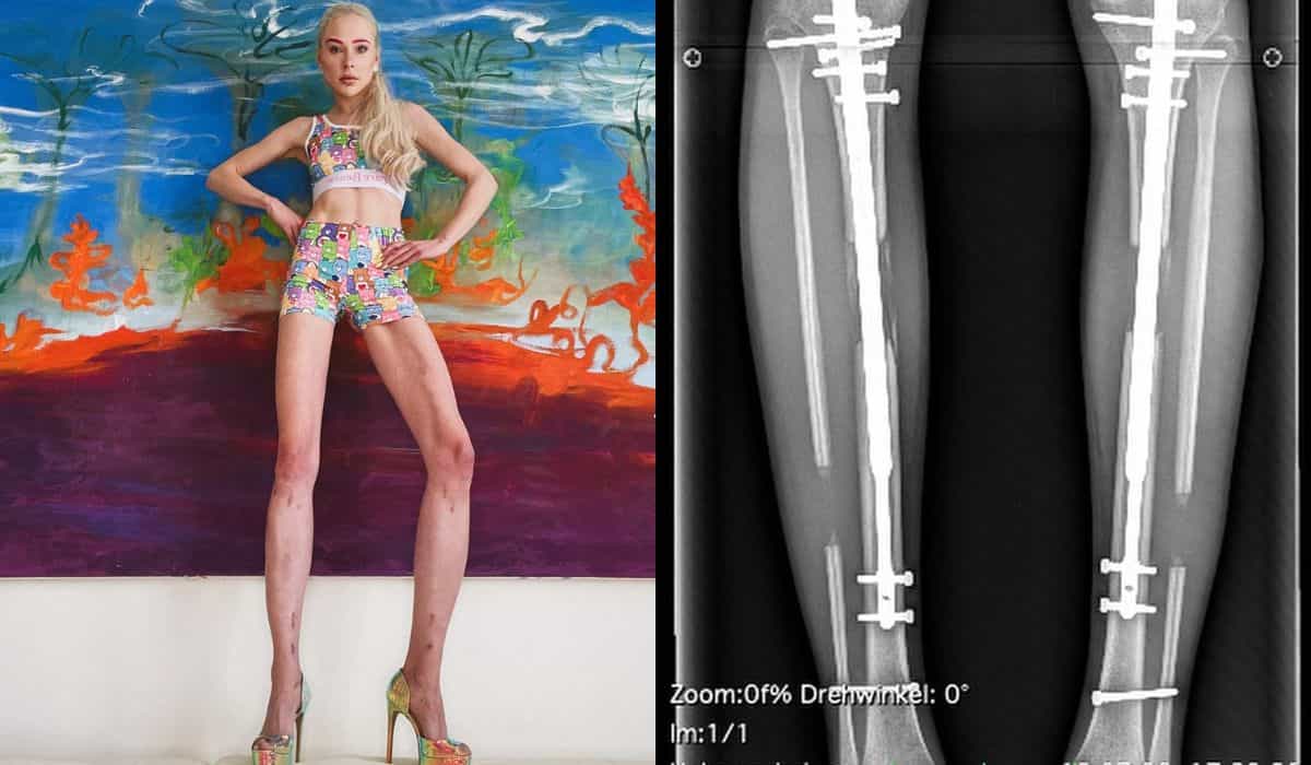 Német modell súlyos szövődményekkel szembesül, miután 160 000 dollárt költött a lábait meghosszabbító műtétre