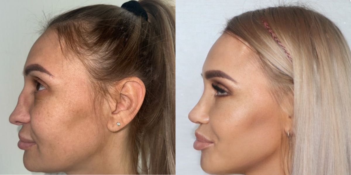 Antes e Depois: Mulher faz transformação drástica no rosto e choca internautas 
