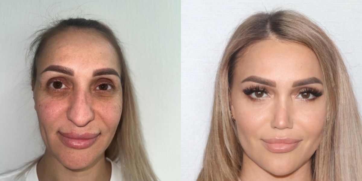 Antes e Depois: Mulher faz transformação drástica no rosto e choca internautas