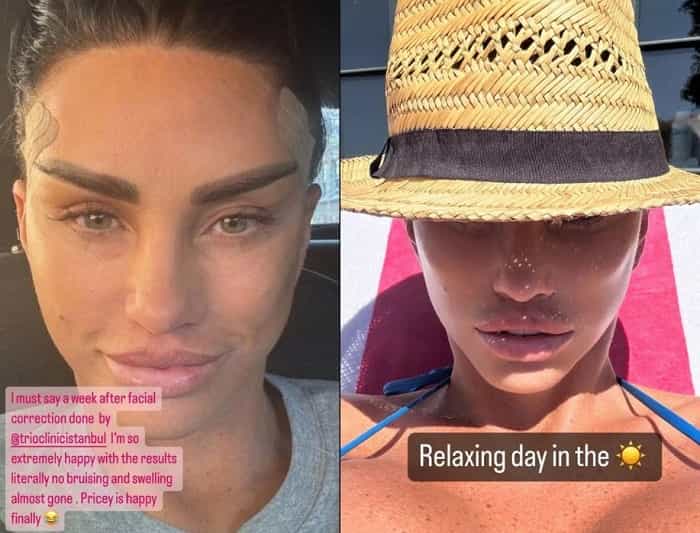 Katie Price viser ny look etter ny plastisk kirurgi: 'ekstremt glad' (Instagram / @katieprice)