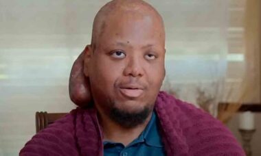 Internautas reagem a homem que tirou tumor do "tamanho de um melão" de sua cabeça. Foto: Reprodução Youtube @TLC