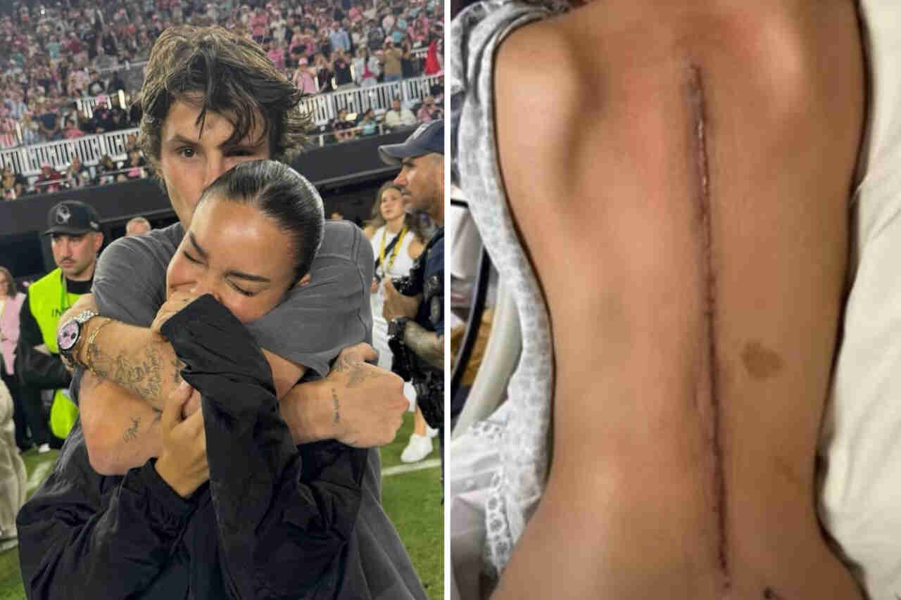 Brazilian girlfriend of Cruz Beckham talks about health while showing giant scar on her back